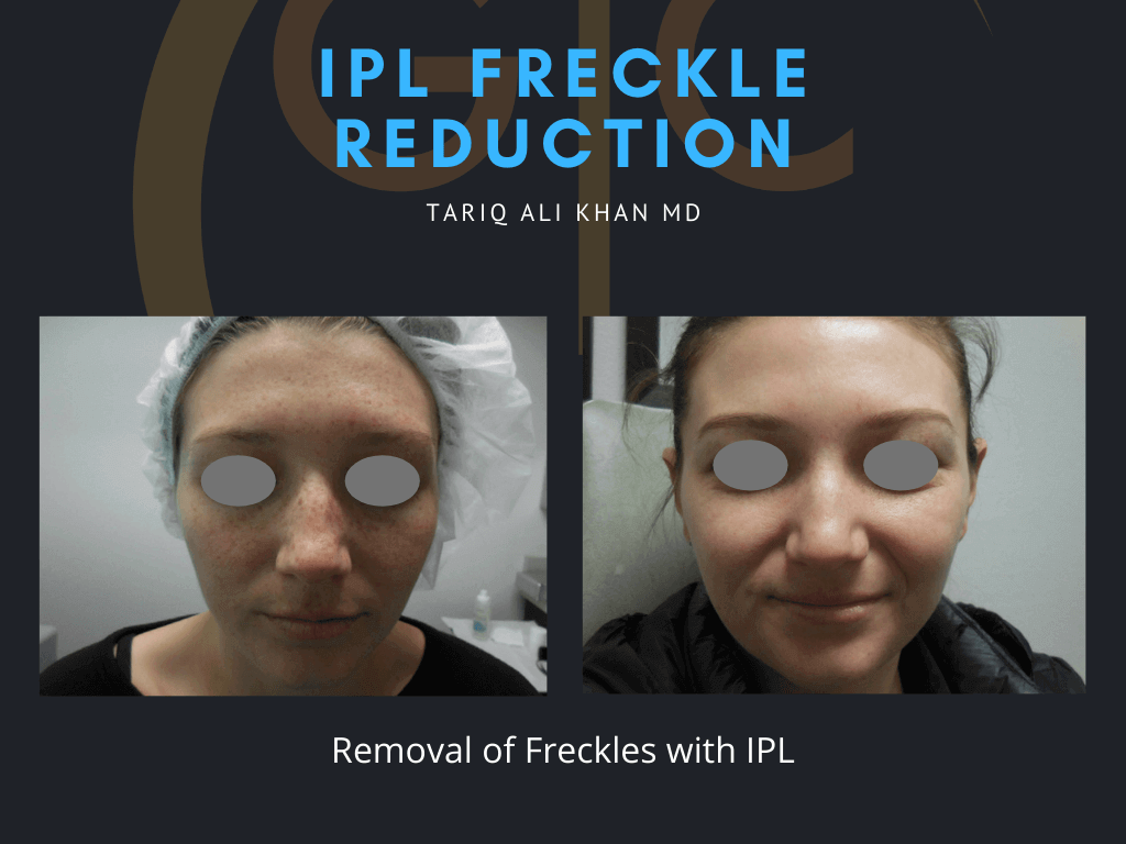 Gentle Care Laser Tustin Before and After picture - Freckle Treatment